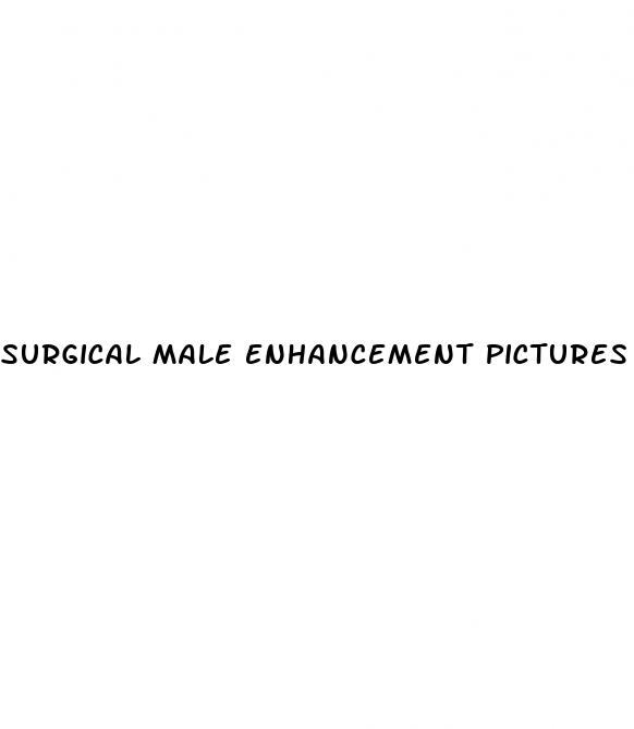 surgical male enhancement pictures