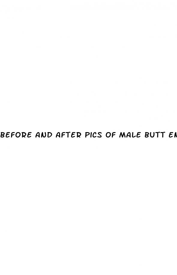 before and after pics of male butt enhancement